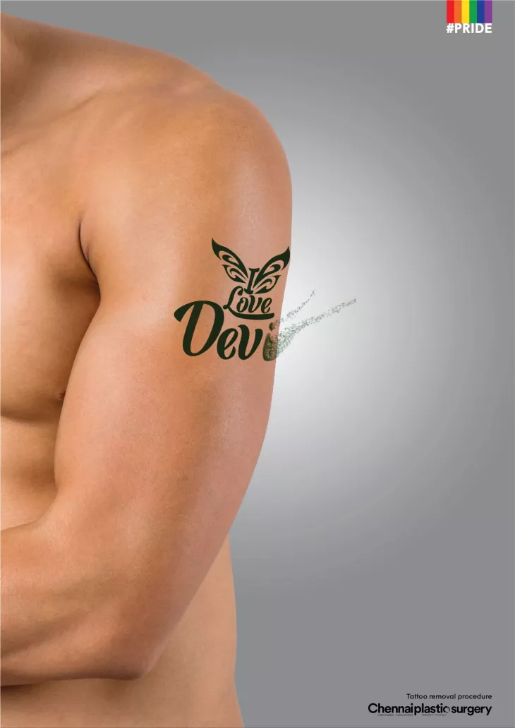 Tattoo Removal: 6 Methods to Consider
