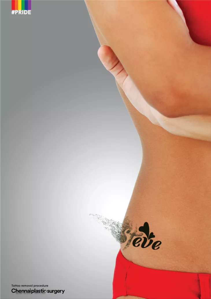 Tattoo Removal Procedure